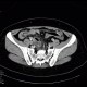 Acute appendicitis, pelvic position: CT - Computed tomography